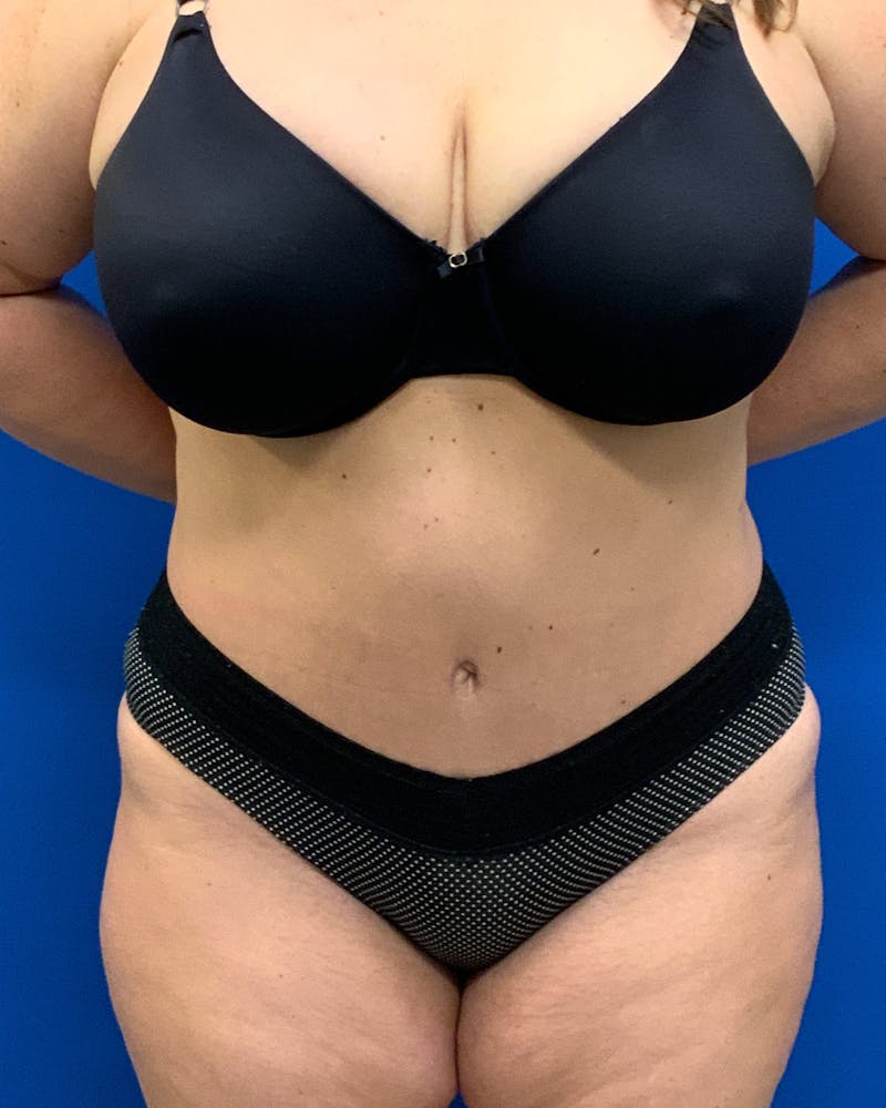 Abdominoplasty Before & After Gallery - Patient 159704 - Image 2