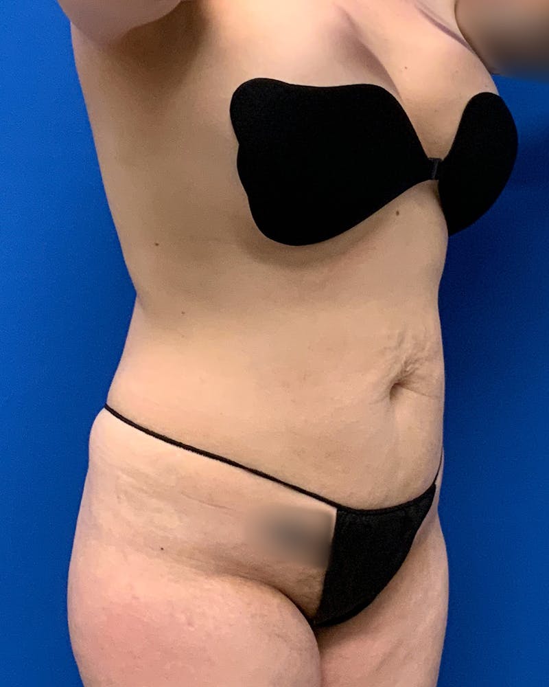 Patient PJkNoMX4RSCtVmXUaSgkPw - Tummy Tuck Before & After Photos