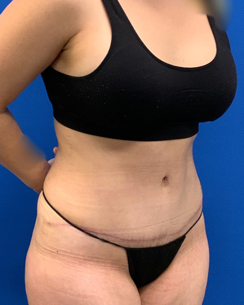 Abdominoplasty Before & After Gallery - Patient 637575 - Image 2