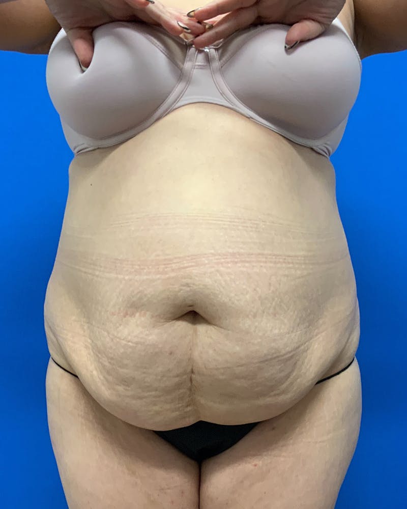 Abdominoplasty Before & After Gallery - Patient 307988 - Image 1