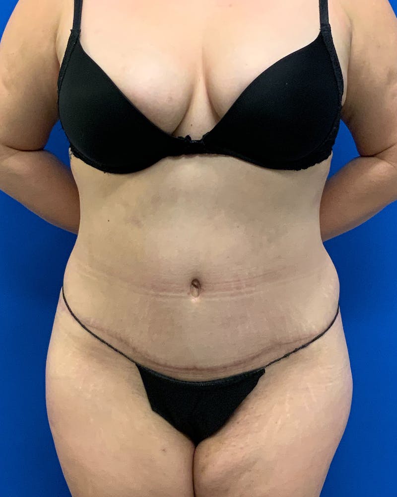 Abdominoplasty Before & After Gallery - Patient 307988 - Image 2