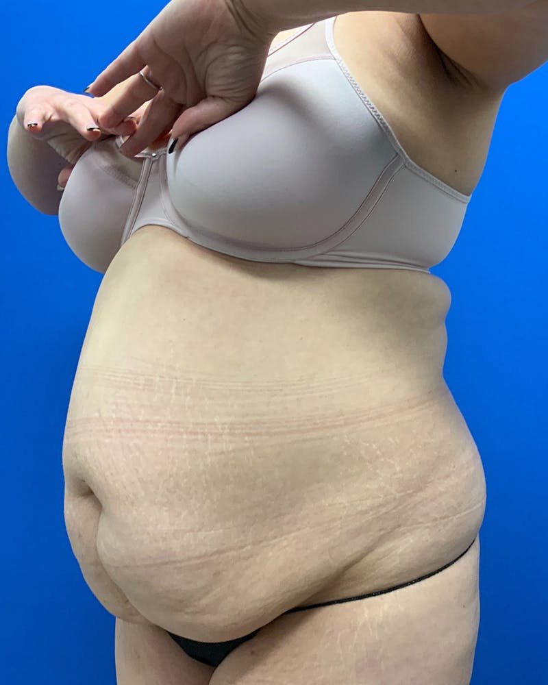 Abdominoplasty Before & After Gallery - Patient 307988 - Image 3