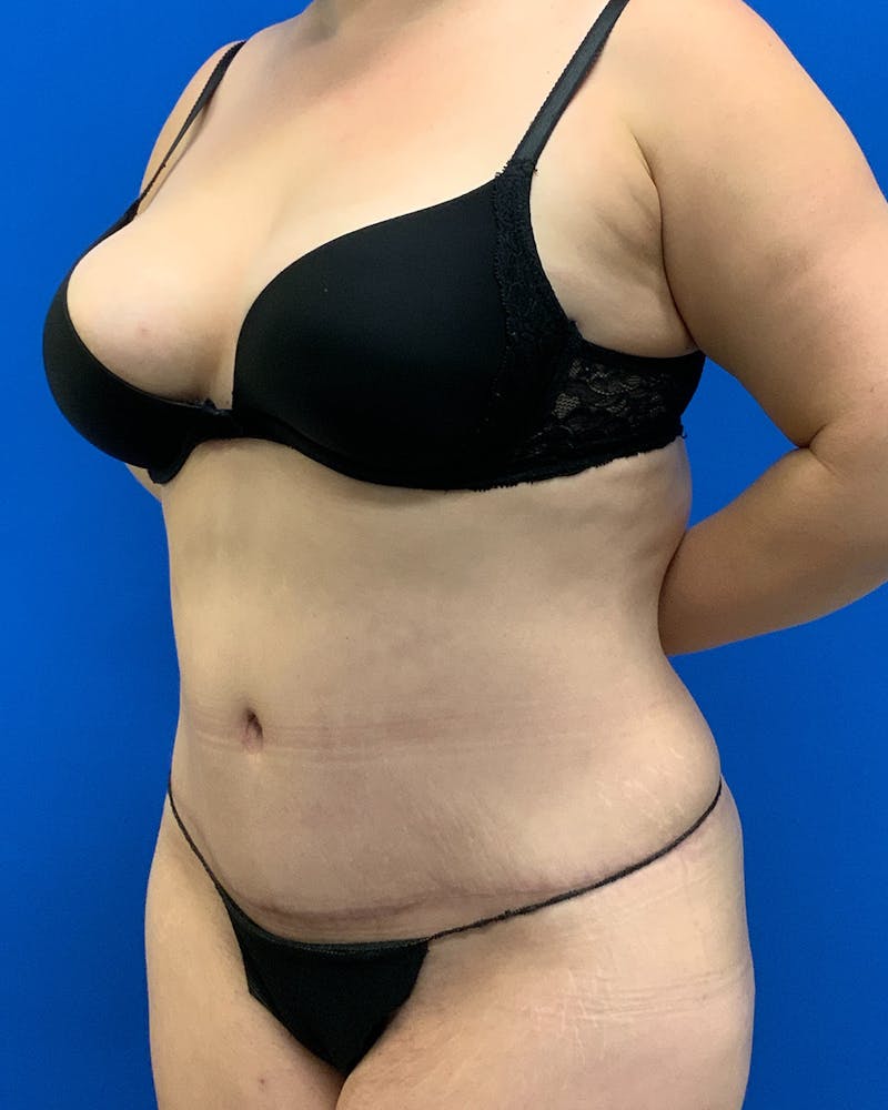 Abdominoplasty Before & After Gallery - Patient 307988 - Image 4