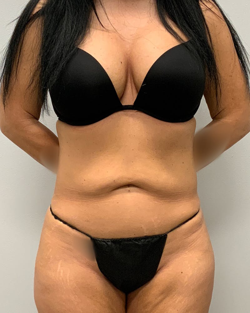 Abdominoplasty Before & After Gallery - Patient 591939 - Image 1