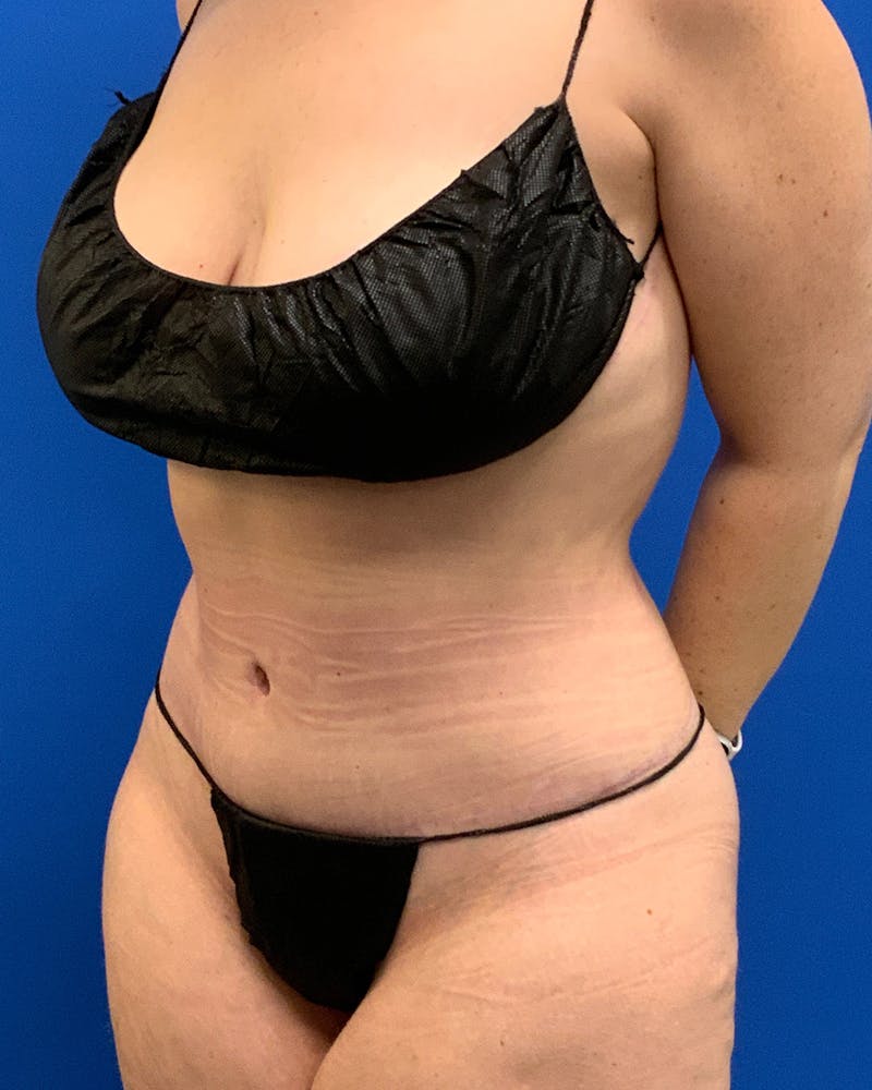 Abdominoplasty Before & After Gallery - Patient 178834 - Image 2