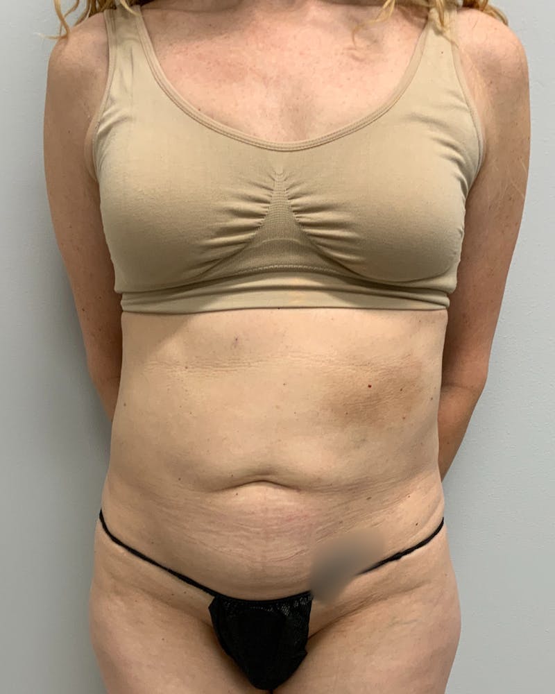 Abdominoplasty Before & After Gallery - Patient 112455 - Image 1