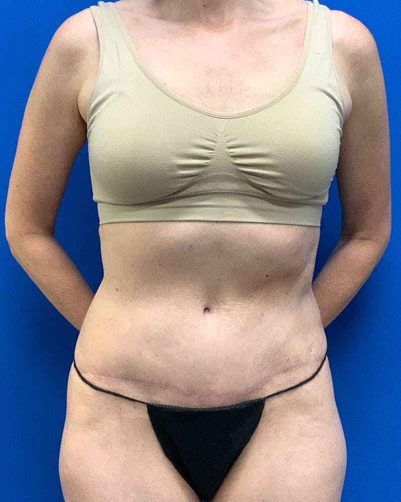 Abdominoplasty Before & After Gallery - Patient 112455 - Image 2