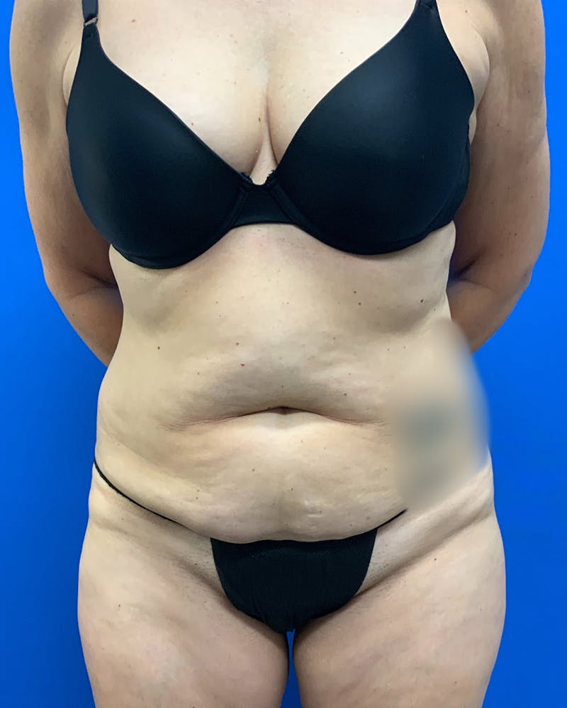 Patient PhUgm1PvS02spHHyg-pkXQ - Tummy Tuck Before & After Photos