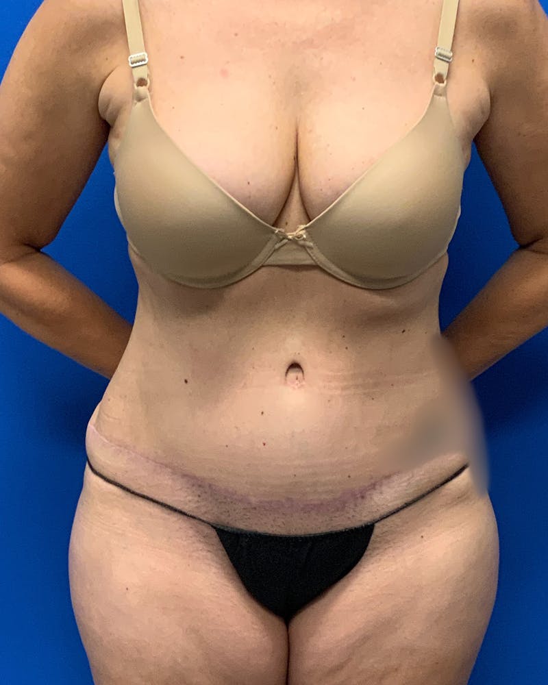 Abdominoplasty Before & After Gallery - Patient 286679 - Image 2