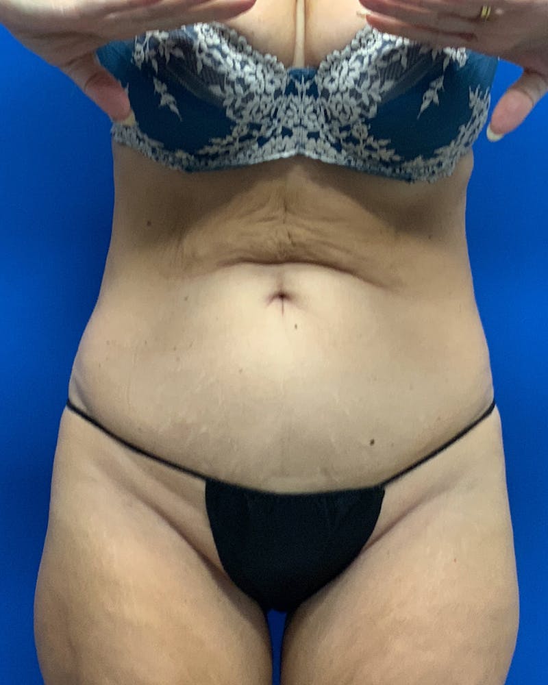 Patient FNtdG27jTQ6QfA7-hBqPYQ - Tummy Tuck Before & After Photos