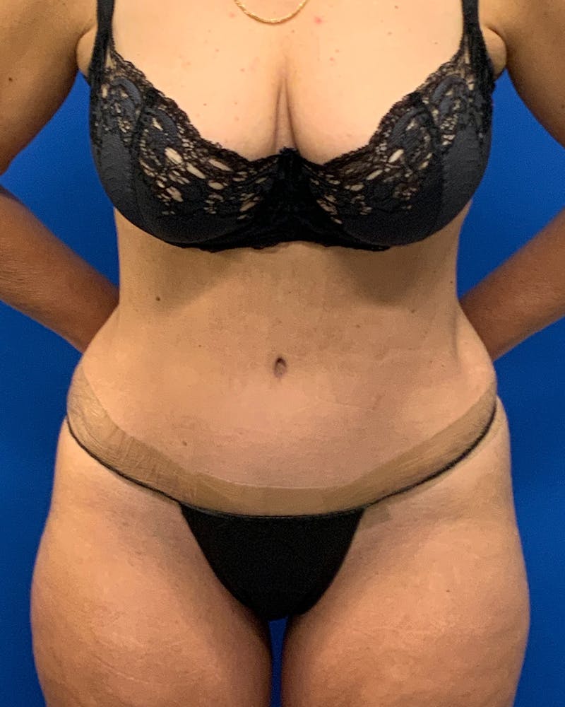 Abdominoplasty Before & After Gallery - Patient 966645 - Image 2