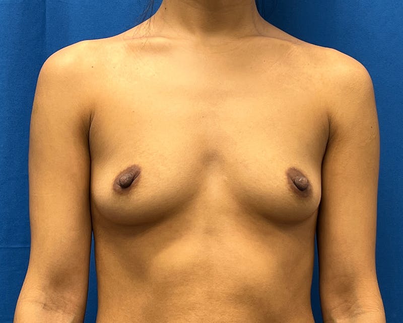 Breast Augmentation Before & After Gallery - Patient 160073 - Image 1
