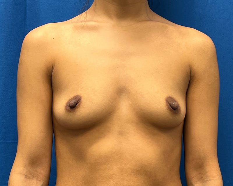 Patient YcpPN9f9RPGqq0uxPQfMcA - Breast Augmentation Before & After Photos