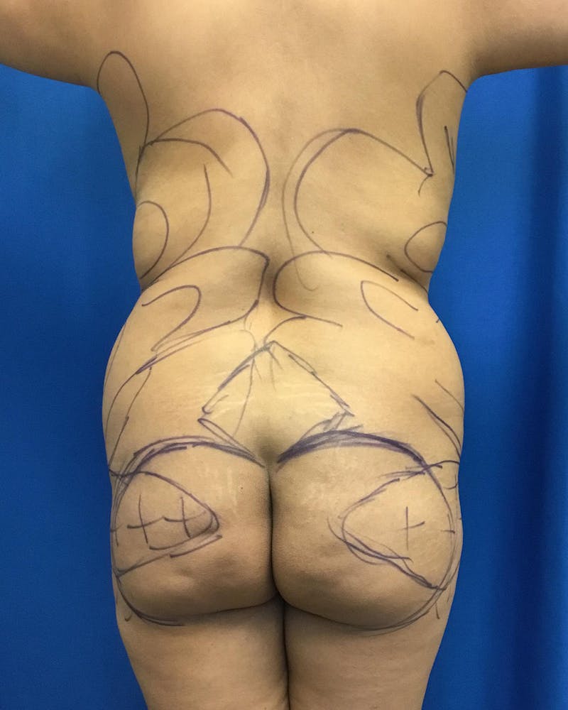 Brazilian Butt Lift Before & After Gallery - Patient 203716 - Image 1