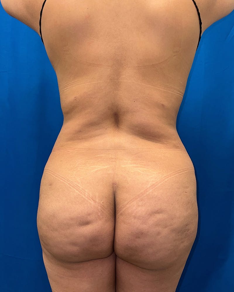 Brazilian Butt Lift Before & After Gallery - Patient 203716 - Image 2