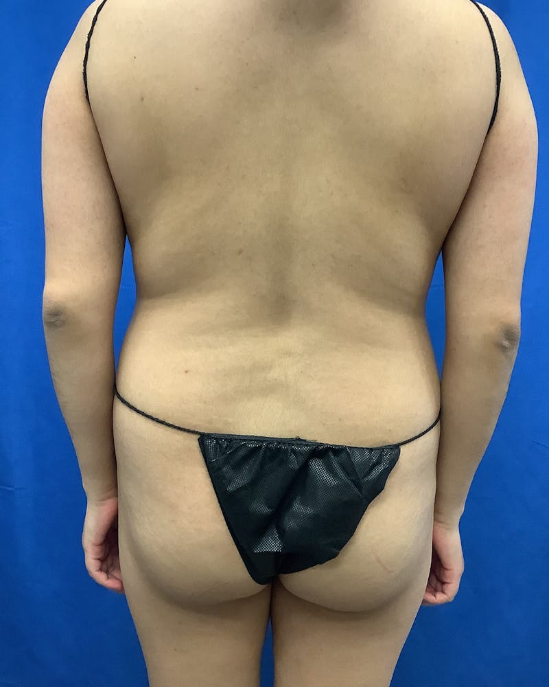 Brazilian Butt Lift Before & After Gallery - Patient 374598 - Image 1