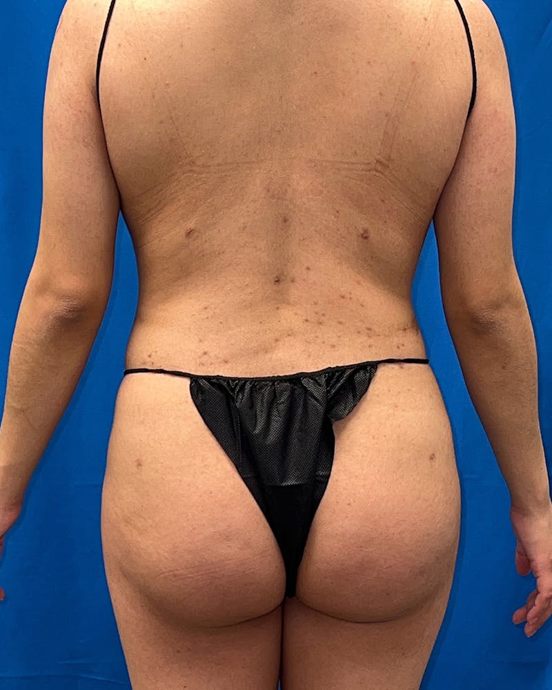 Brazilian Butt Lift Before & After Gallery - Patient 374598 - Image 2