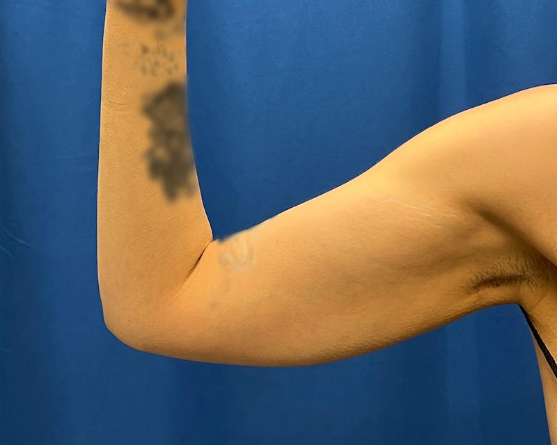 Patient BtF2KdwkTNCReJgt4m2bSQ - Arm Lift Before & After Photos