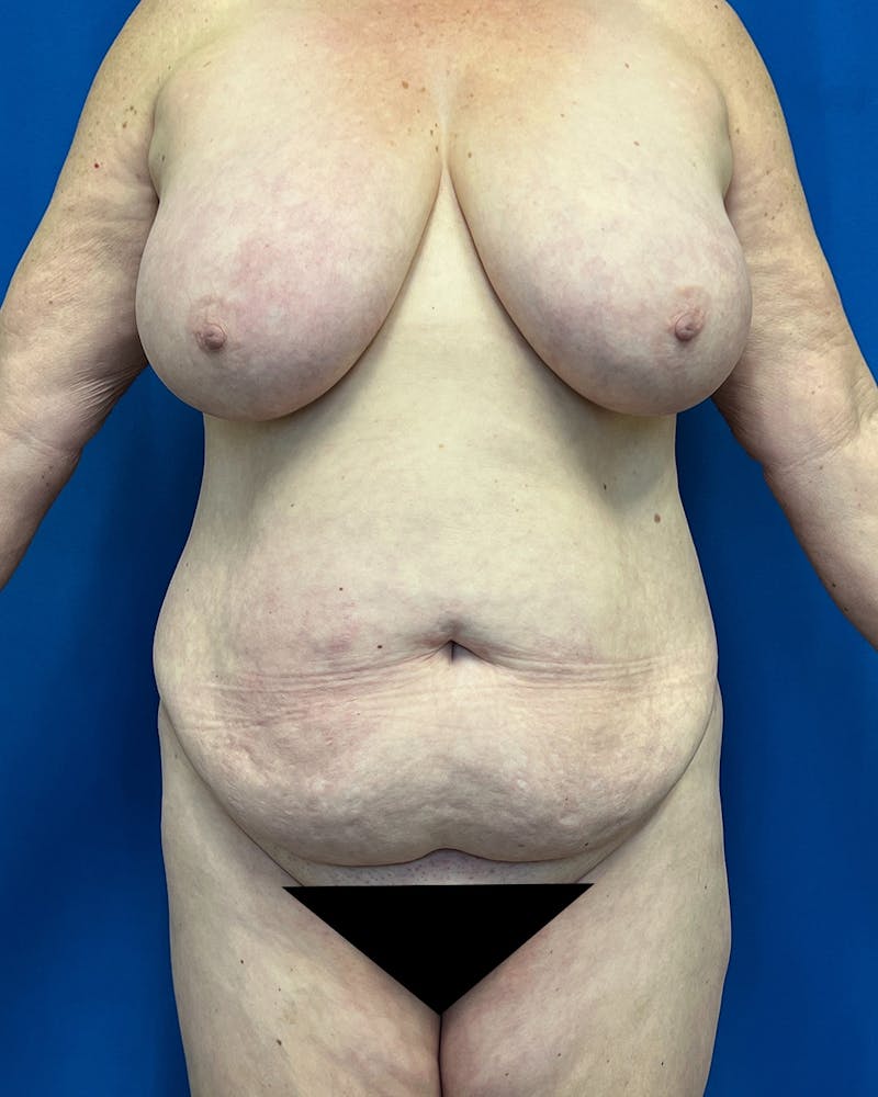 Mommy Makeover Before & After Gallery - Patient 147785 - Image 1