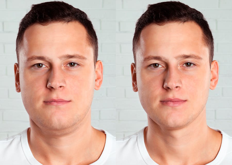 man before and after double chin/neck liposuction