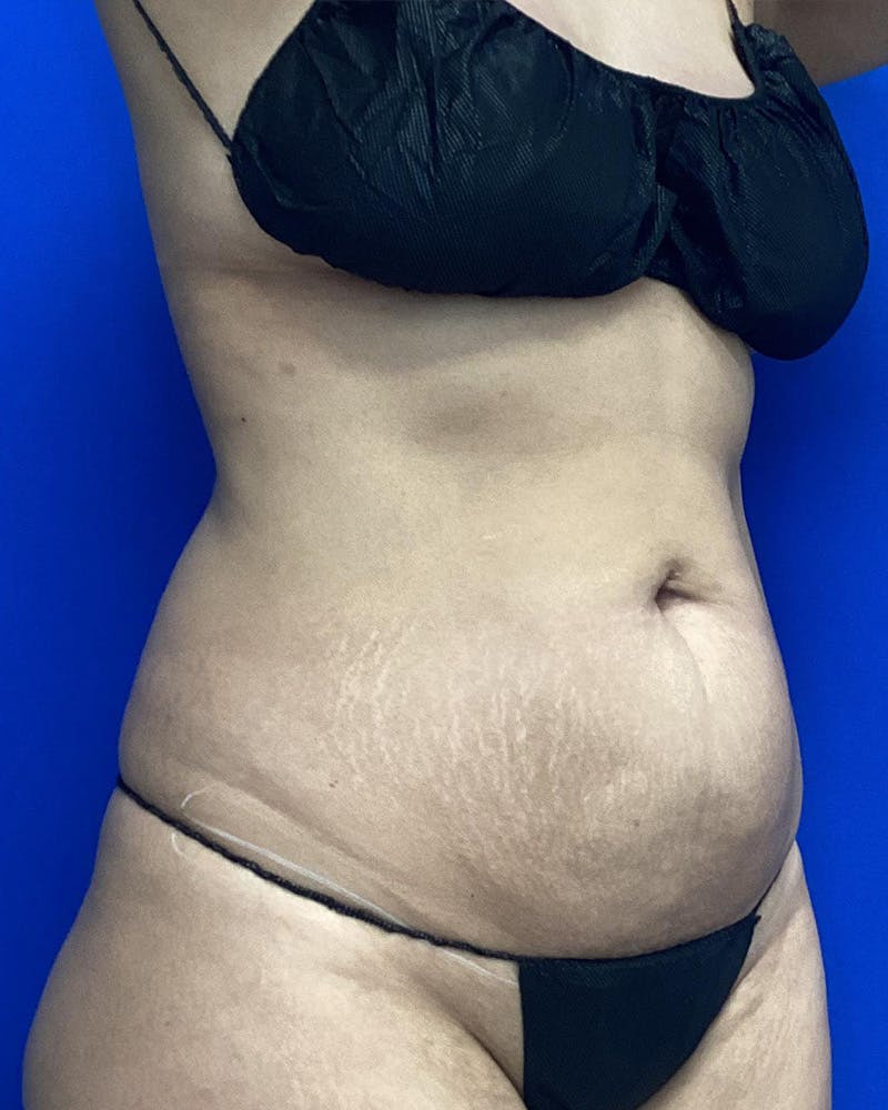 Abdominoplasty Before & After Gallery - Patient 144260 - Image 3