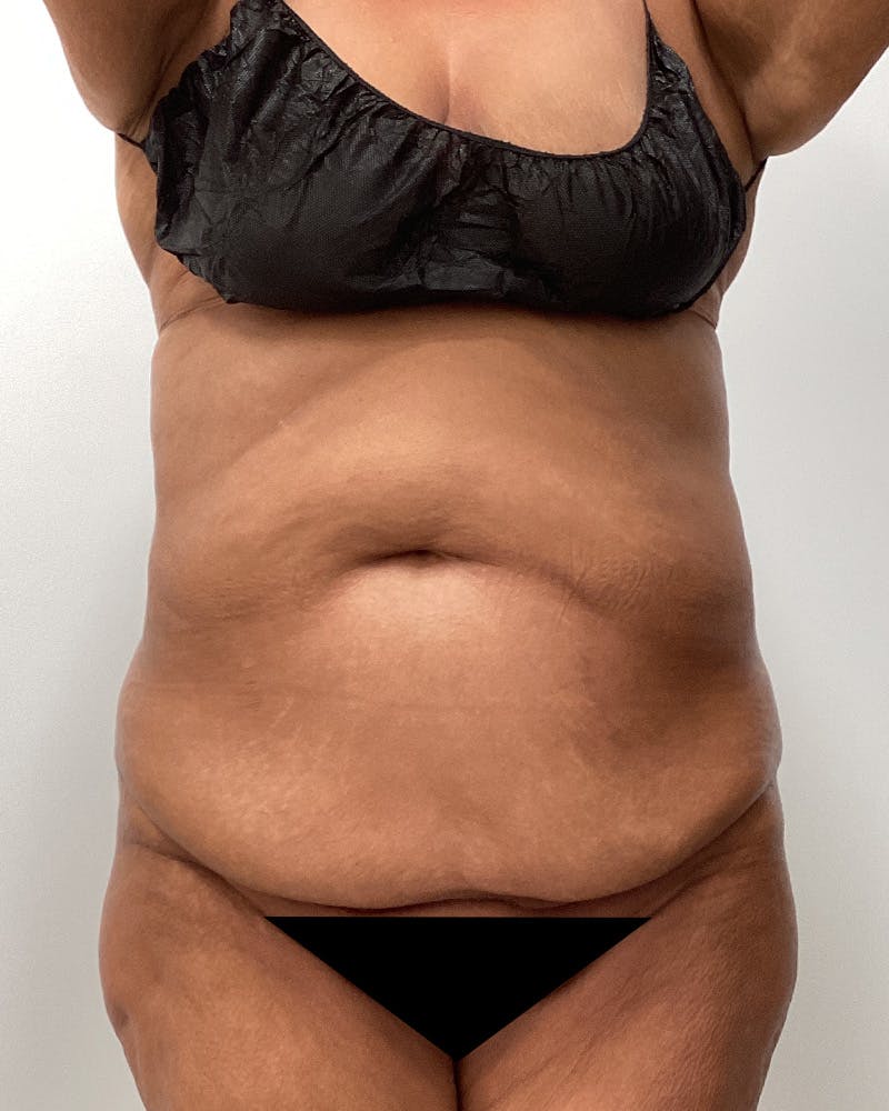 Patient c9w2wFALSqiHvNDfJfMCzQ - Tummy Tuck Before & After Photos