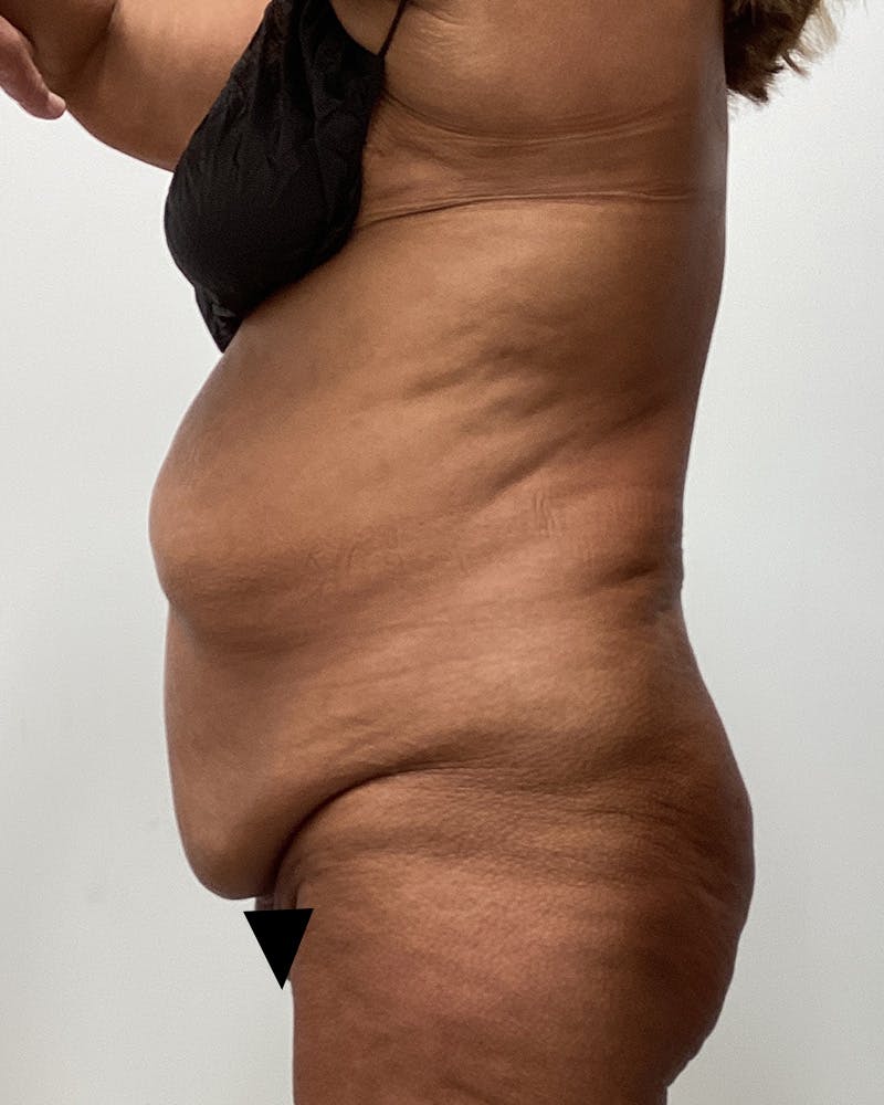 Abdominoplasty Before & After Gallery - Patient 540920 - Image 3