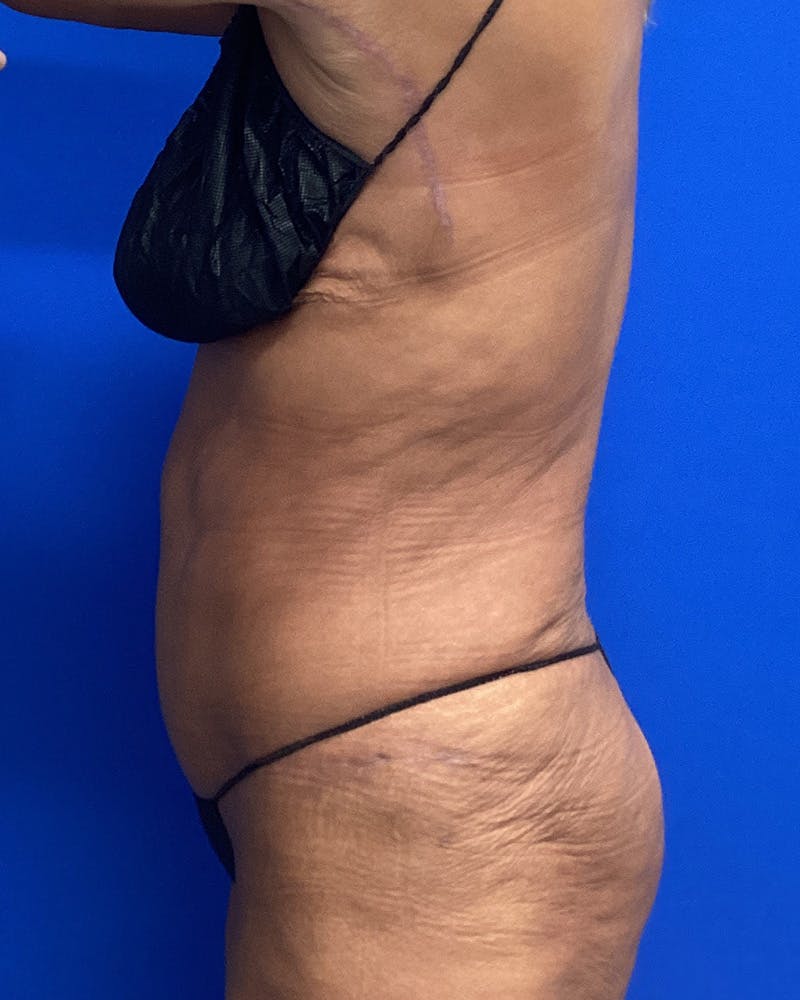 Abdominoplasty Before & After Gallery - Patient 540920 - Image 4