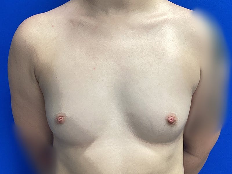 Patient dxWS4SiXRxaz92KJnpdFFA - Breast Augmentation Before & After Photos