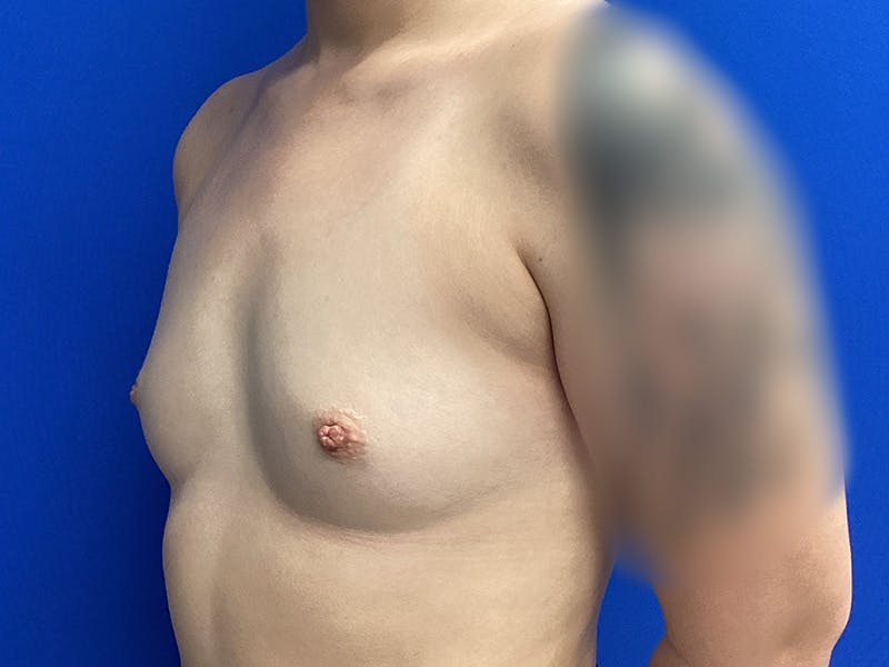 Breast Augmentation Before & After Gallery - Patient 246891 - Image 3