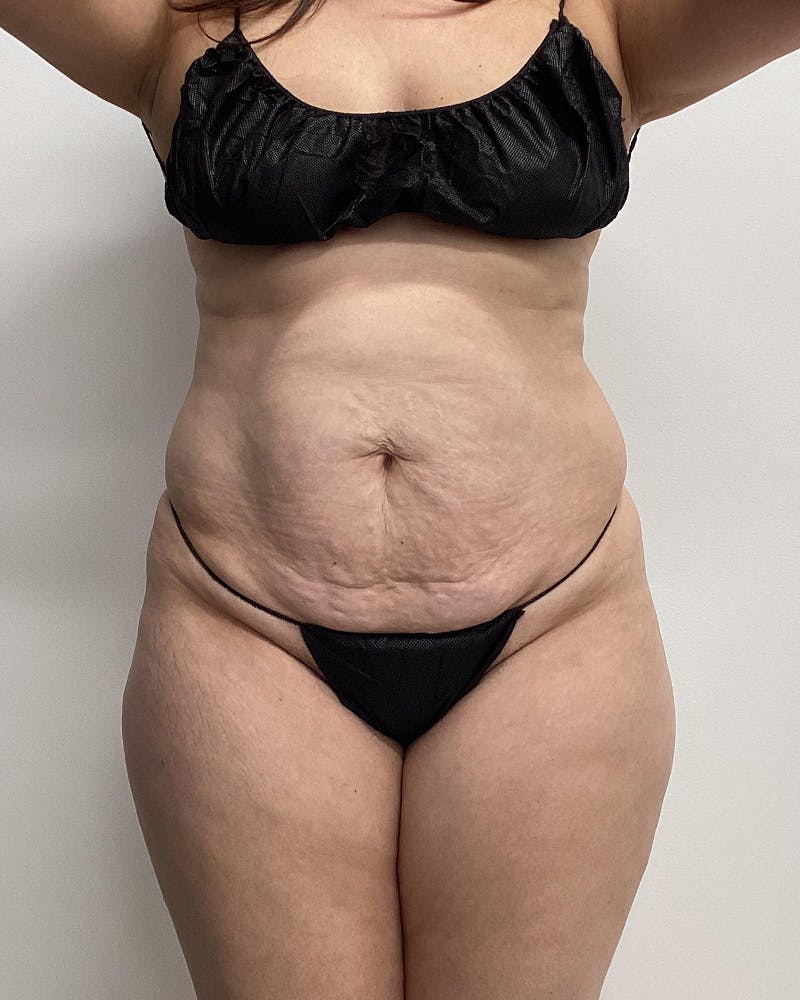 Patient EyCYemeFRg2bQkultIPzLw - Tummy Tuck Before & After Photos
