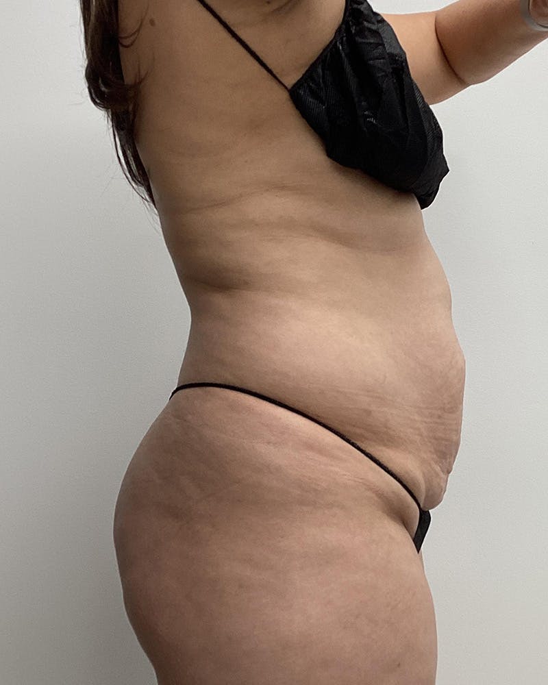 Abdominoplasty Before & After Gallery - Patient 336802 - Image 3