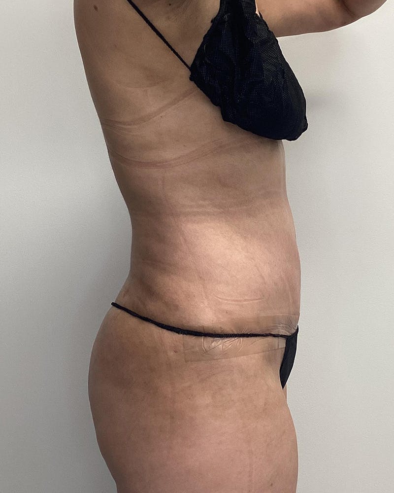 Abdominoplasty Before & After Gallery - Patient 336802 - Image 4