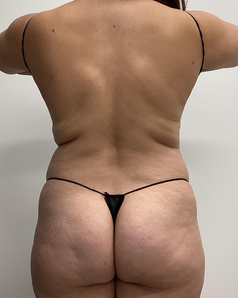 Abdominoplasty Before & After Gallery - Patient 336802 - Image 5