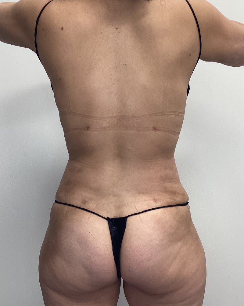 Abdominoplasty Before & After Gallery - Patient 336802 - Image 6