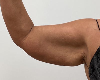 Brachioplasty Before & After Gallery - Patient 903157 - Image 1