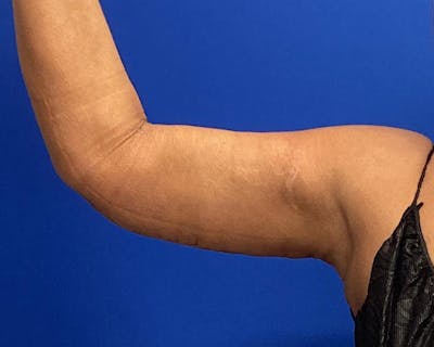 Brachioplasty Before & After Gallery - Patient 903157 - Image 2