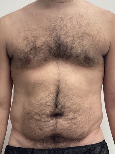 Liposuction Before & After Gallery - Patient 284752 - Image 1