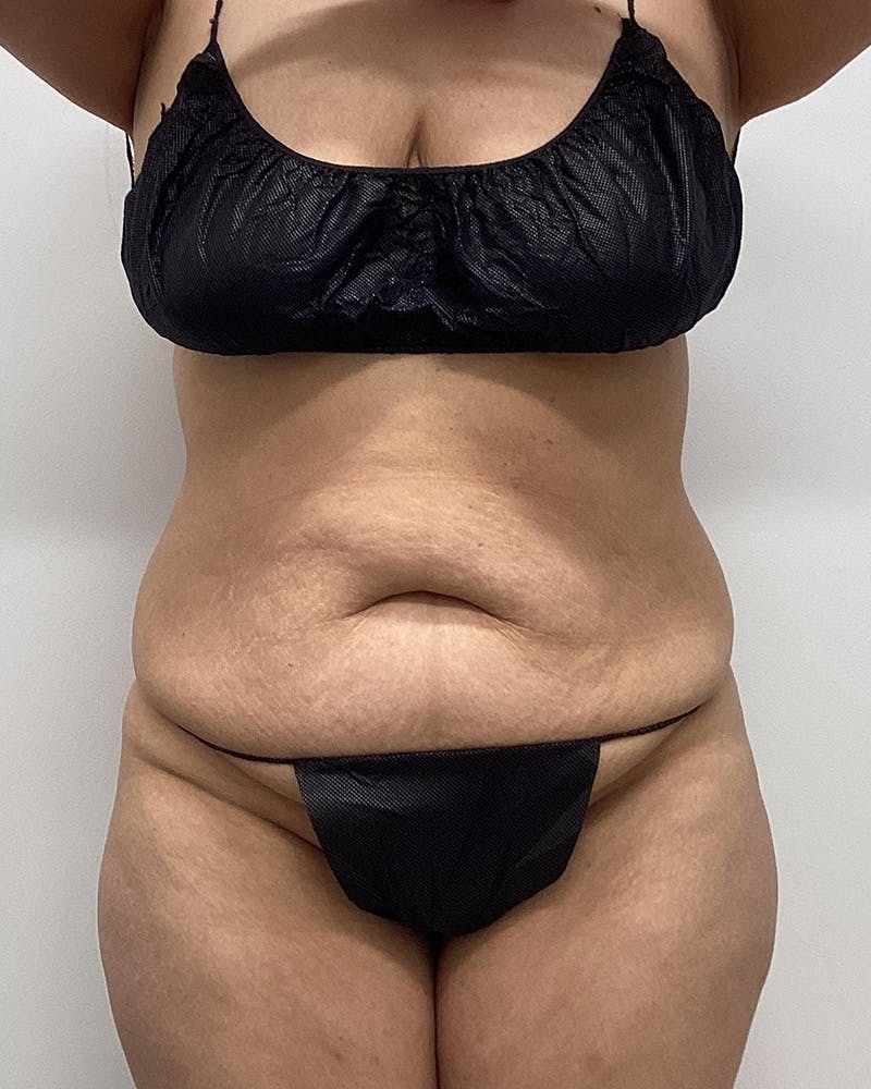 Patient PgRf8fP-Tg29fFJdqMer2g - Tummy Tuck Before & After Photos