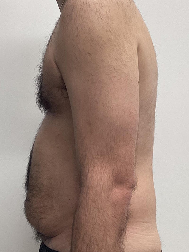 Liposuction Before & After Gallery - Patient 284752 - Image 3