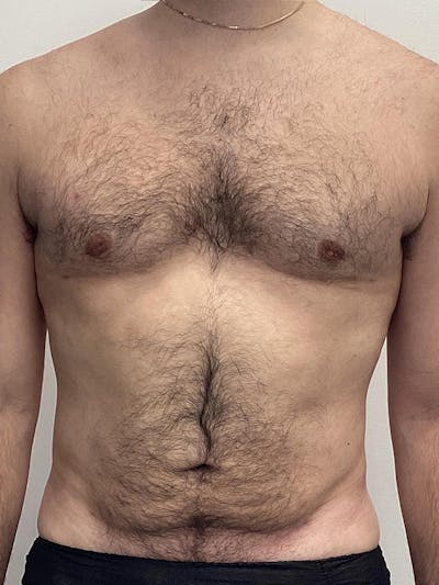 Liposuction Before & After Gallery - Patient 284752 - Image 2