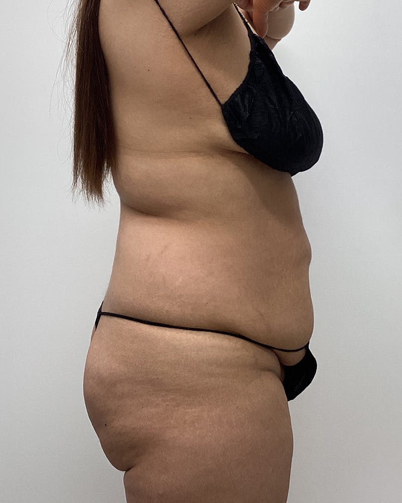 Abdominoplasty Before & After Gallery - Patient 191209 - Image 3