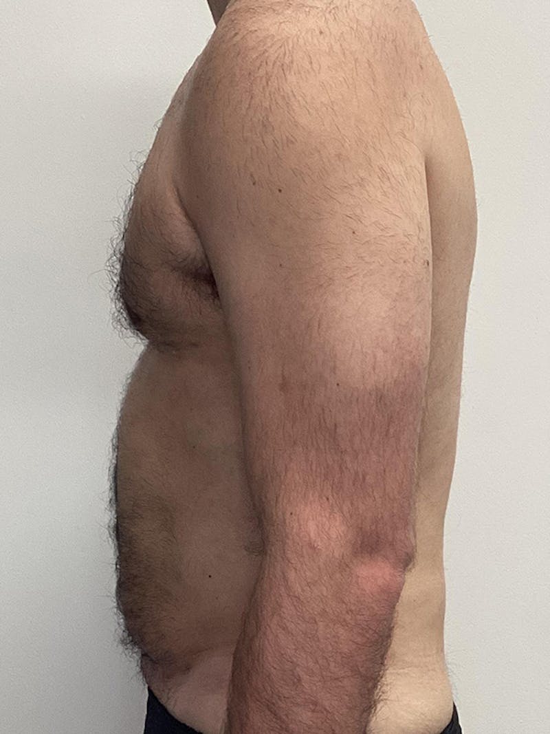 Liposuction Before & After Gallery - Patient 284752 - Image 4