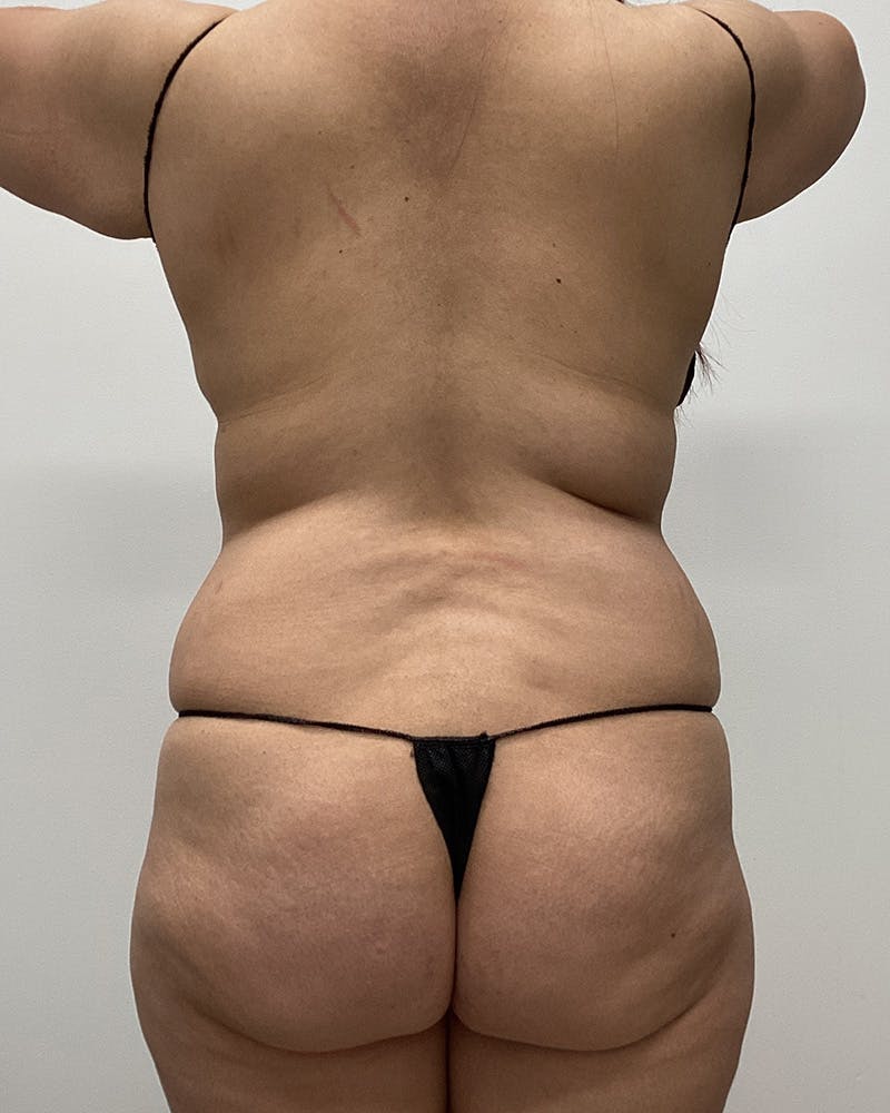 Abdominoplasty Before & After Gallery - Patient 191209 - Image 5
