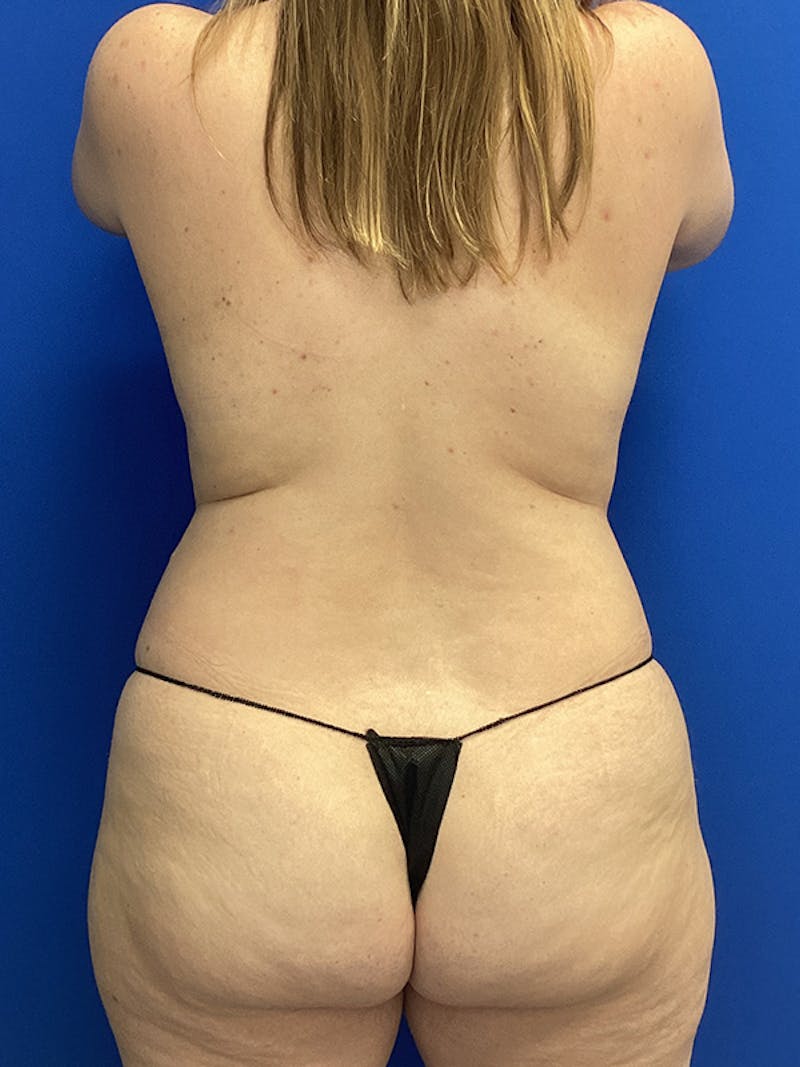 Liposuction Before & After Gallery - Patient 187032 - Image 3