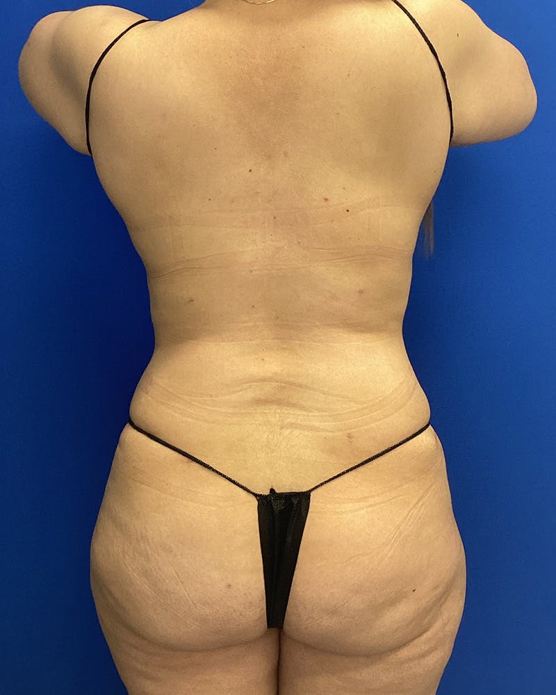 Abdominoplasty Before & After Gallery - Patient 191209 - Image 6