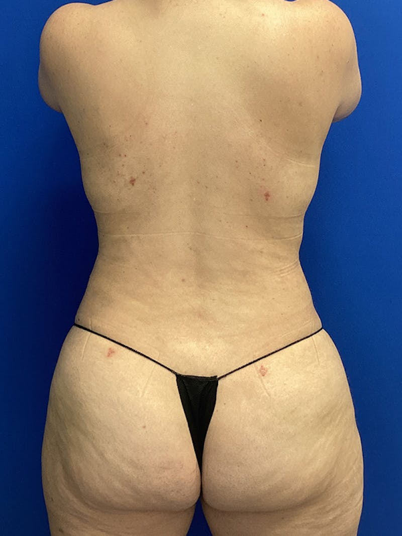 Liposuction Before & After Gallery - Patient 187032 - Image 4
