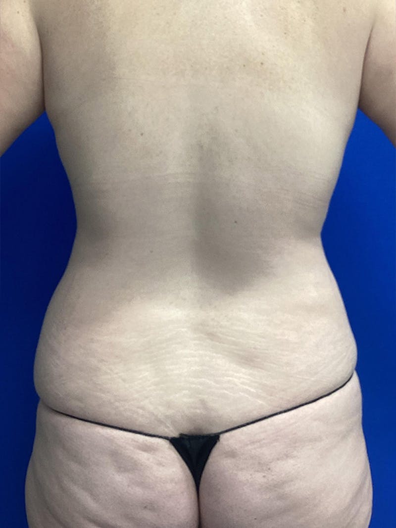 Liposuction Before & After Gallery - Patient 292034 - Image 3
