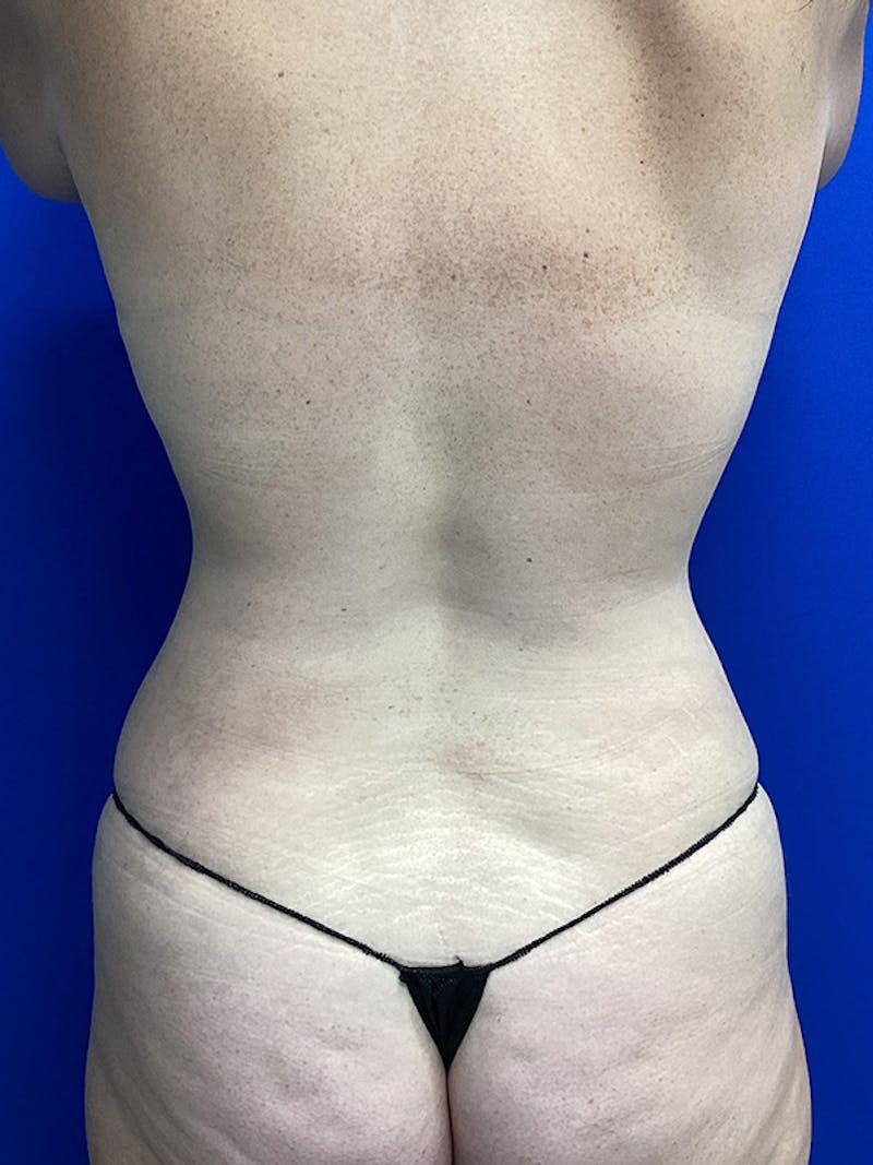 Liposuction Before & After Gallery - Patient 292034 - Image 4