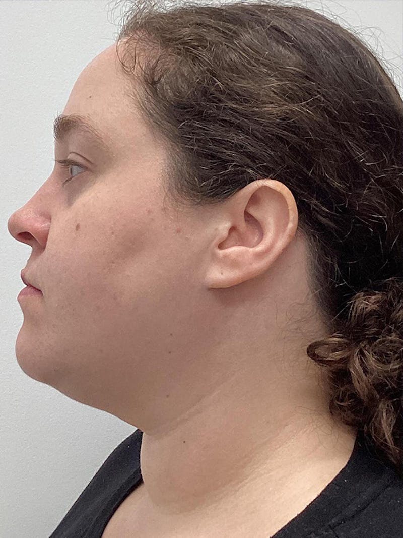 Patient PY8Fn-ZhQui848I0xRXCoQ - Chin & Neck Liposuction Before & After Photos